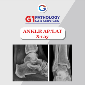 X-Ray Ankle AP/LAT