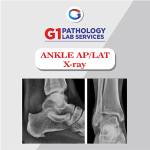 X-Ray Ankle AP/LAT