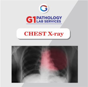 X-Ray Chest PA