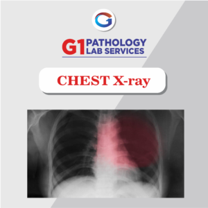 X-Ray Chest PA