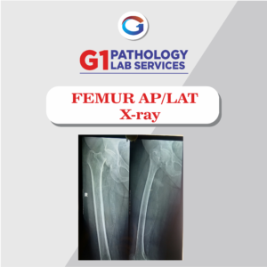 X-Ray Femur AP/LAT