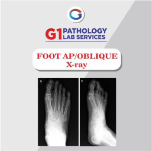 X-Ray Foot AP/Oblique