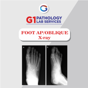 X-Ray Foot AP/Oblique