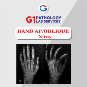 X-Ray Hand AP/OBLIQUE