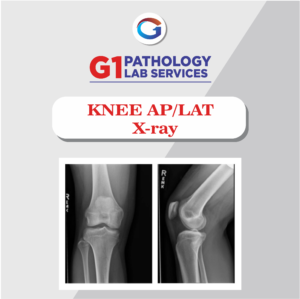 X-Ray Knee AP/LAT