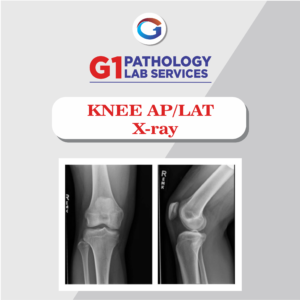 X-Ray Knee AP/LAT