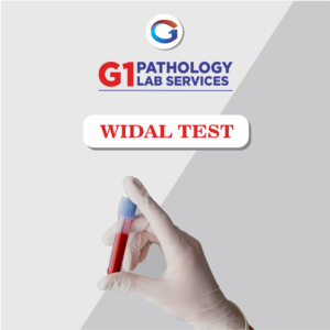 Widal Test